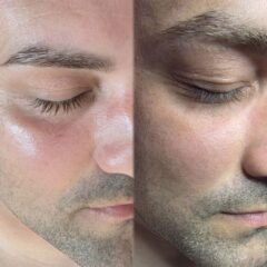 Tratament facial lifting